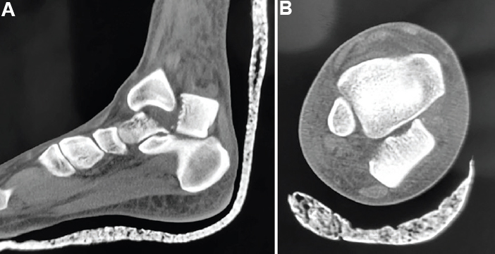 Sagittal (A) and axial (B) views of non-contrast computed tomography showing fracture neck of talus with posterior extrusion of talar body.